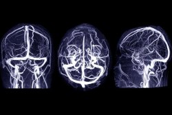 New technique might better treat hematoma brain bleeds