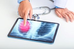 Report finds big improvement in lung cancer survival